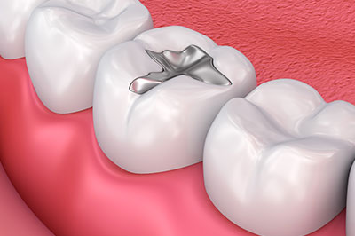 Islip Amalgam Fillings