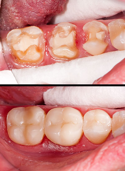 Composite Fillings Islip