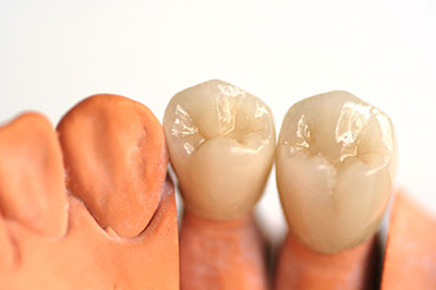 Dental Caps in Islip