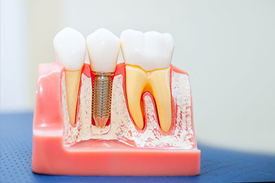 Dental implants in Islip