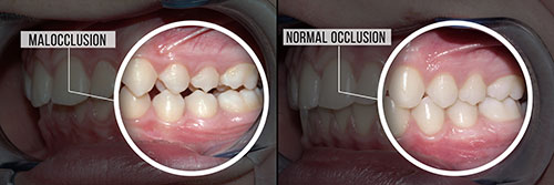 Malocclusion in Islip