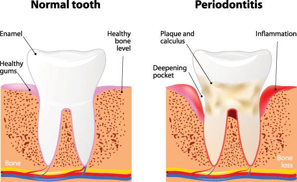 Periodontal Disease in Islip