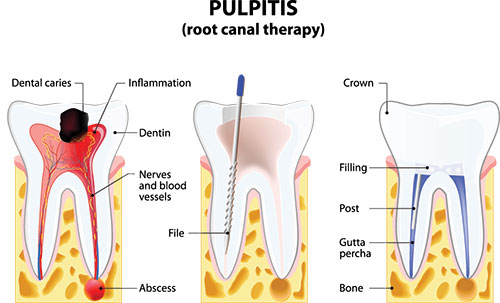 Root Canals in Islip