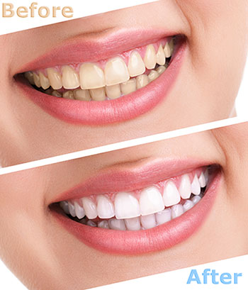 Islip teeth whitening