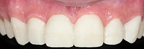Islip Before and After Dental Bleaching