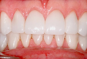 Before and After Dental Braces in Islip