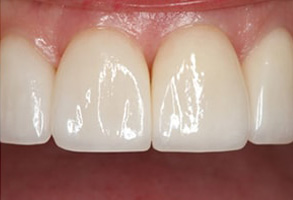 Before and After Teeth Whitening in Islip