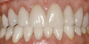 Before and After Veneers in Islip