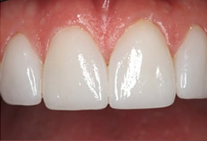 Before and After Invisalign in Islip