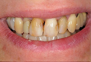 Islip Teeth Whitening