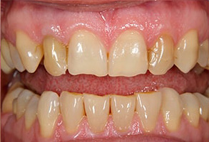 Islip Porcelain Veneers