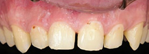 Before and After Dental Implants in Islip