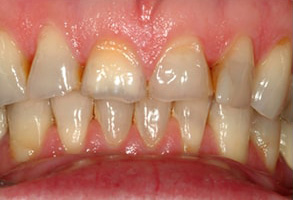 Before and After Dental Bleaching in Islip