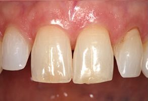 Islip Before and After Dental Braces