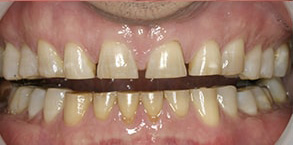 Islip Before and After Teeth Whitening