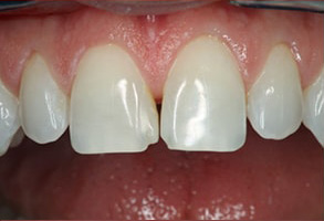 Islip Before and After Veneers